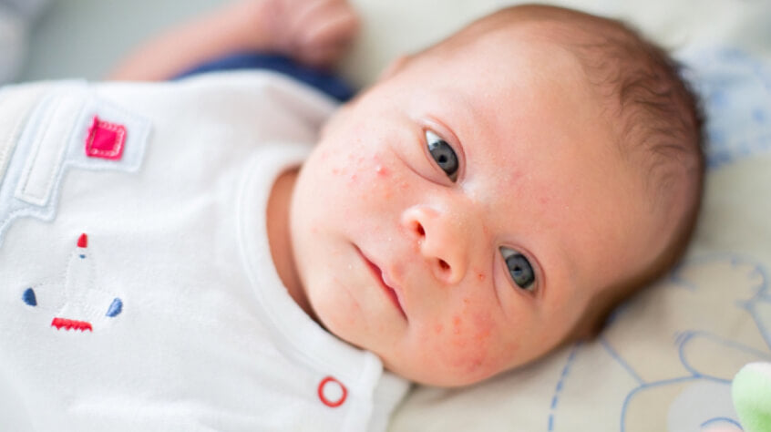 bebek aknesi nedir
